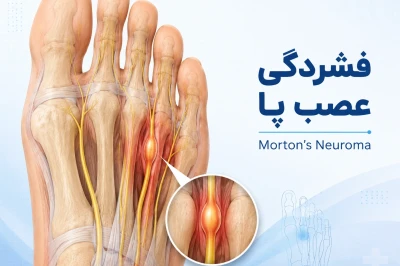 فشردگی اعصاب پا (Morton’s Neuroma) | تشخیص و درمان تخصصی درد بین انگشتان پا