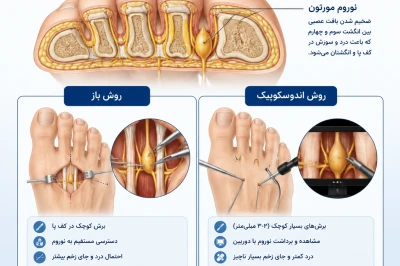 جراحی نوروم مورتون با روش باز و اندوسکوپیک | بررسی روش‌های درمان درد عصب کف پا
