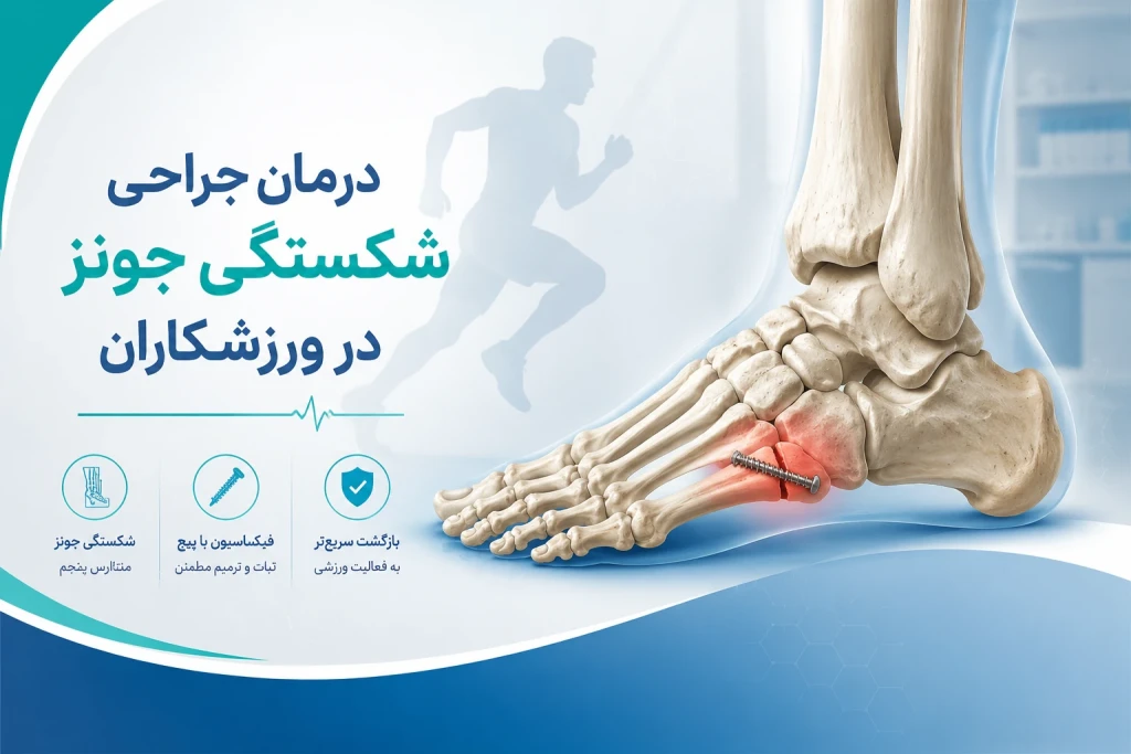 درمان جراحی شکستگی جونز در ورزشکاران | بررسی روش‌های تخصصی درمان شکستگی متاتارس پنجم