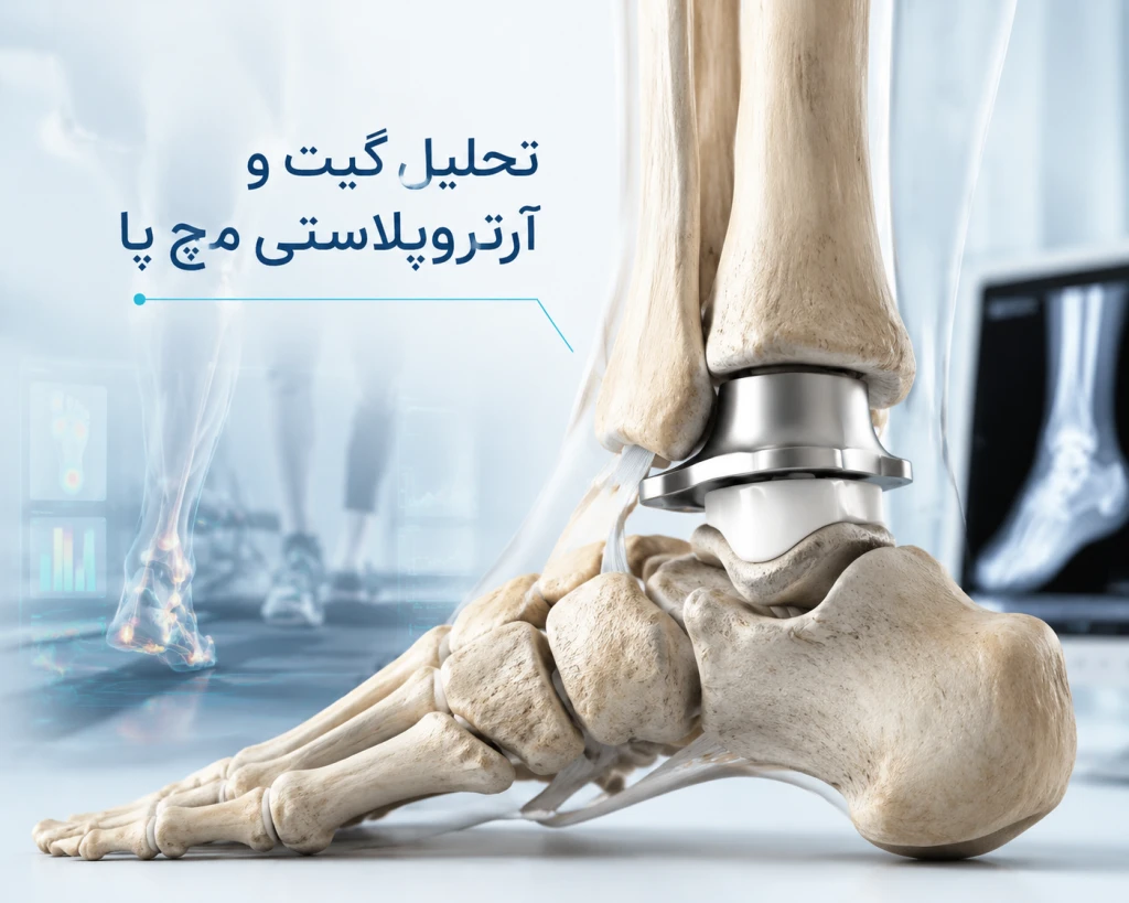تحلیل گیت پس از آرتروپلاستی مچ پا | بررسی الگوی راه‌رفتن پس از جراحی تعویض مفصل مچ پا