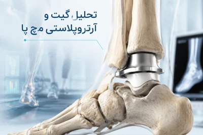 تحلیل گیت پس از آرتروپلاستی مچ پا | بررسی الگوی راه‌رفتن پس از جراحی تعویض مفصل مچ پا