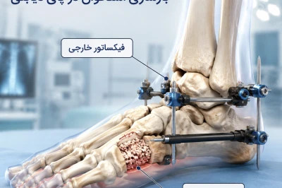 روش‌های نوین بازسازی استخوان در پای دیابتی | درمان تخصصی بدشکلی‌های اسکلتی