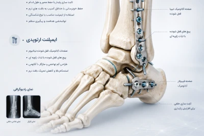 اصول انتخاب ایمپلنت مناسب در جراحی‌های پا و مچ پا | راهنمای تخصصی تصمیم‌گیری درمانی