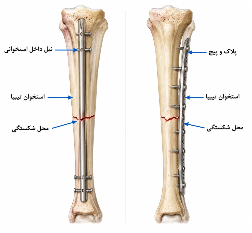 مقایسه نیل داخل استخوانی و پلاک در شکستگی تیبیا | بررسی انتخاب بهترین روش تثبیت ساق پا