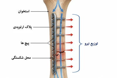 بیومکانیک استخوان و اصول بارگذاری در فیکساتورهای ارتوپدی | تحلیل مهندسی در جراحی استخوان