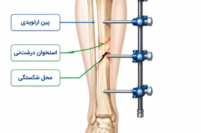 اصول استفاده از فیکساتور خارجی در تروماهای اندام تحتانی | راهنمای جامع تثبیت شکستگی‌های پیچیده