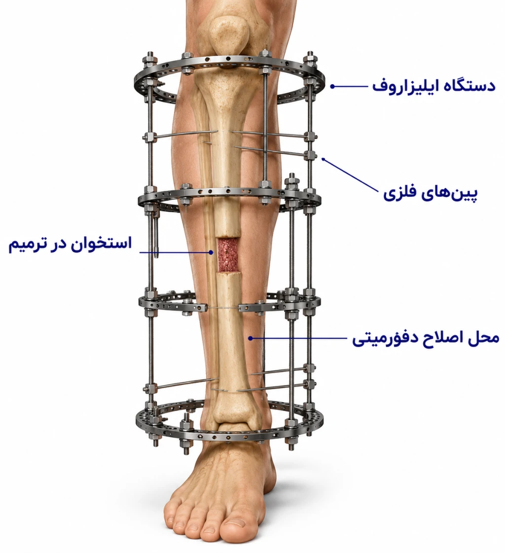 تکنیک ایلیزاروف در اصلاح دفورمیتی‌های استخوانی| بازسازی پیشرفته اندام
