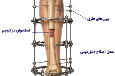 تکنیک ایلیزاروف در اصلاح دفورمیتی‌های استخوانی| بازسازی پیشرفته اندام
