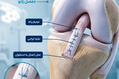 ارزیابی قدرت کششی بخیه‌ها در ترمیم رباط‌ها | بررسی استحکام بخیه در جراحی رباط