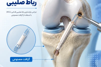 استفاده از گرافت‌های مصنوعی در بازسازی رباط| رویکردهای نوین جراحی ارتوپدی