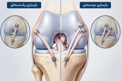 تفاوت بازسازی یک‌دسته‌ای و دودسته‌ای در جراحی ACL | مقایسه تکنیک‌های جراحی رباط صلیبی