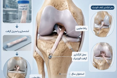 استفاده از گرافت‌های آلوژنتیک در ترمیم لیگامان | بررسی مزایا و نتایج بالینی