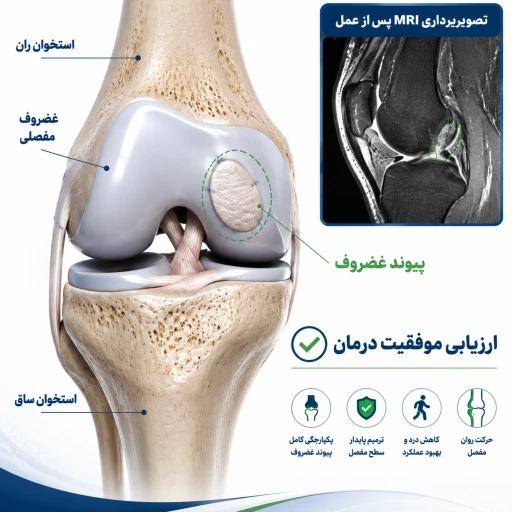 ارزیابی موفقیت پیوند غضروف با MRI پس از عمل | بررسی نتایج بازسازی غضروف مفصل