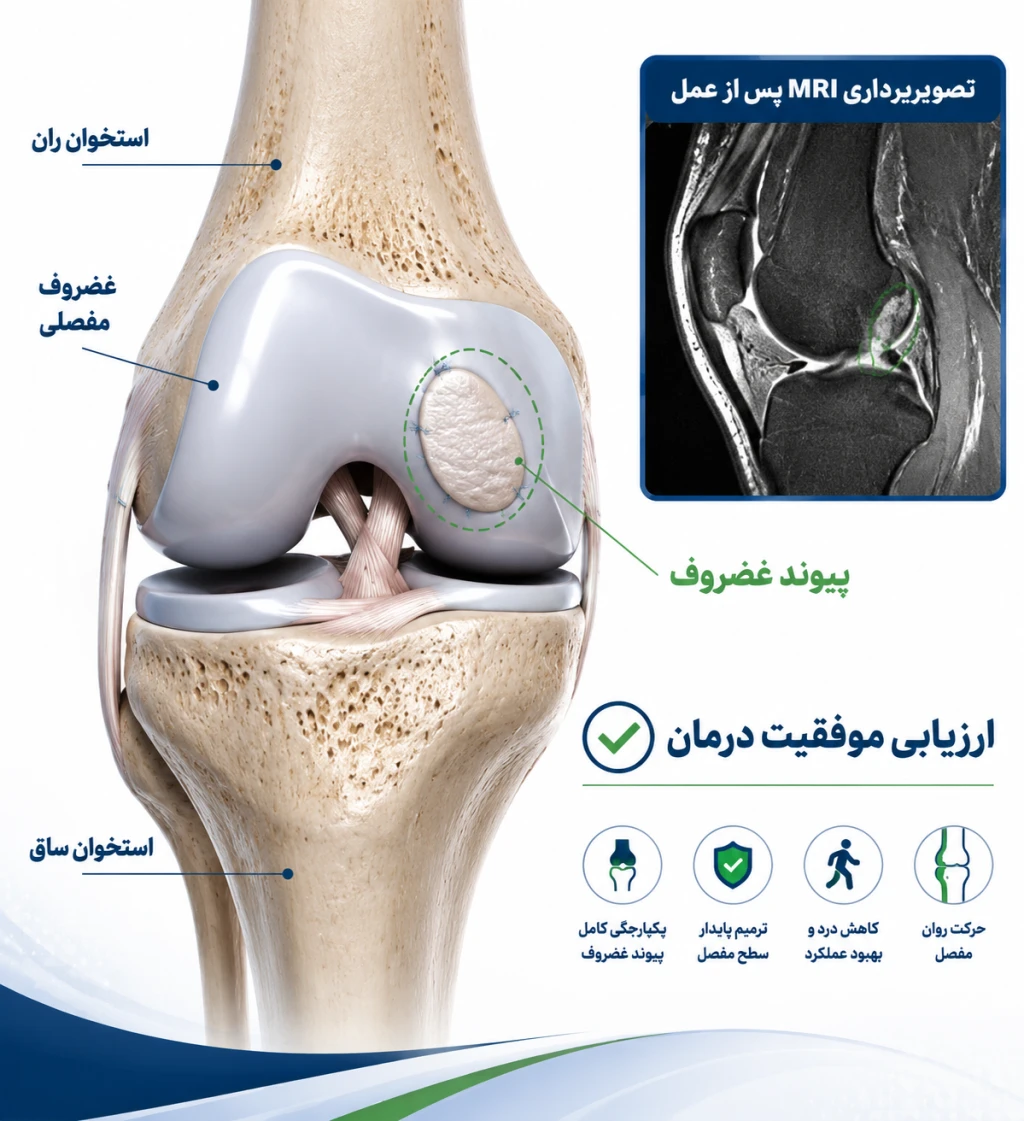 ارزیابی موفقیت پیوند غضروف با MRI پس از عمل | بررسی نتایج بازسازی غضروف مفصل