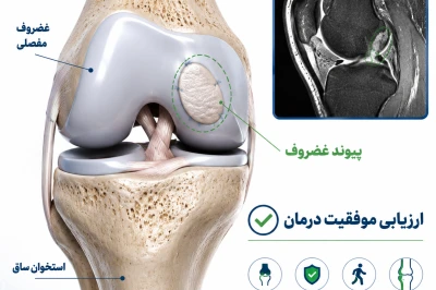 ارزیابی موفقیت پیوند غضروف با MRI پس از عمل | بررسی نتایج بازسازی غضروف مفصل