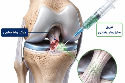 استفاده از Stem Cell Therapy در ترمیم رباط‌های آسیب‌دیده | رویکرد نوین بازسازی بافت‌های رباطی