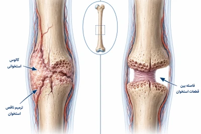 استراتژی‌های درمانی در شکستگی‌های تأخیری و نان‌یونین (Nonunion) | بررسی روش‌های نوین ترمیم استخوان