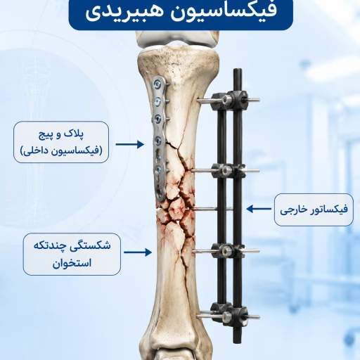 اصول فیکساسیون هیبریدی در شکستگی‌های پیچیده | رویکرد نوین در تثبیت شکستگی‌های چندتکه
