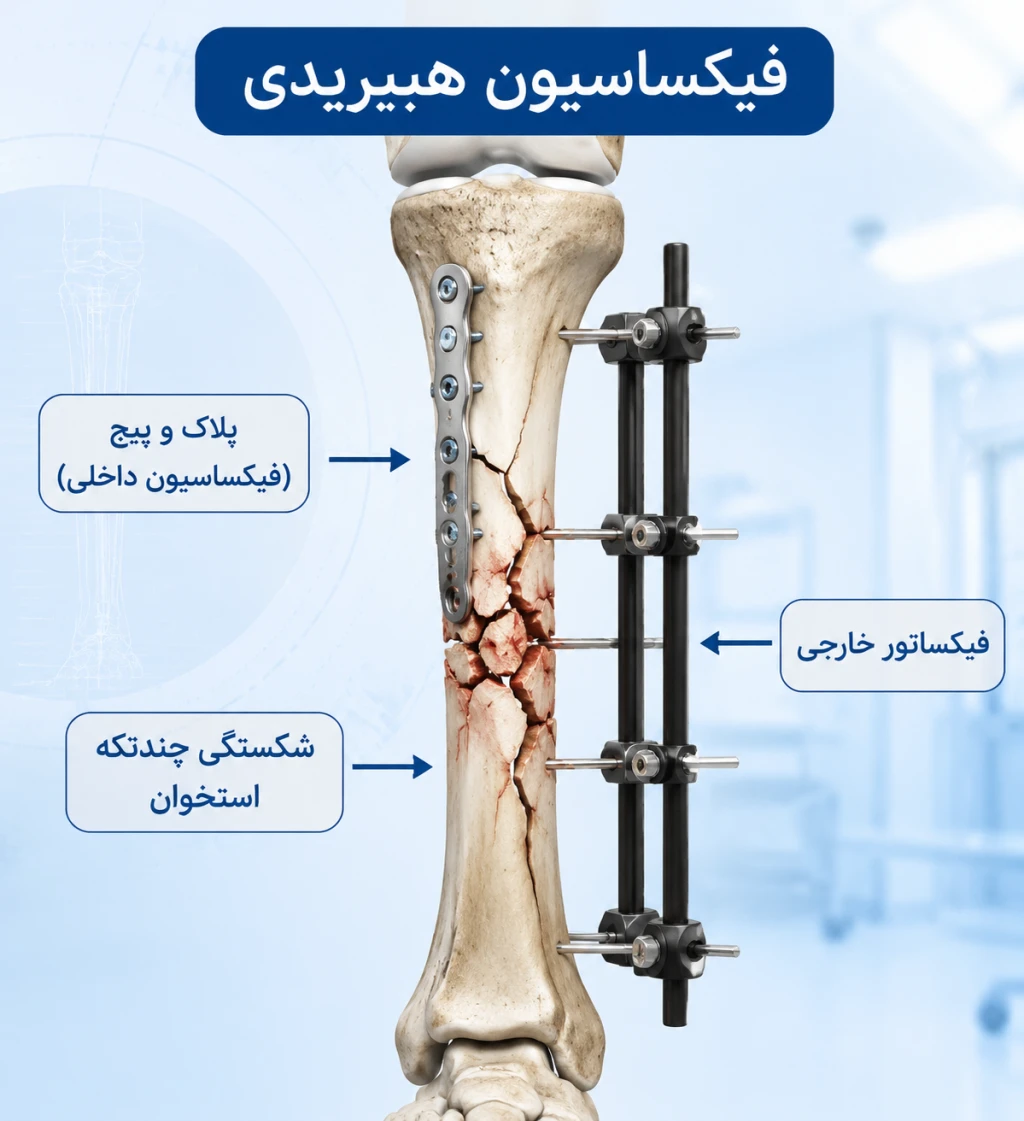 اصول فیکساسیون هیبریدی در شکستگی‌های پیچیده | رویکرد نوین در تثبیت شکستگی‌های چندتکه