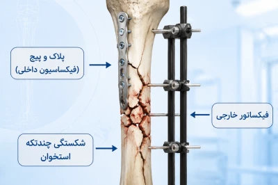 اصول فیکساسیون هیبریدی در شکستگی‌های پیچیده | رویکرد نوین در تثبیت شکستگی‌های چندتکه