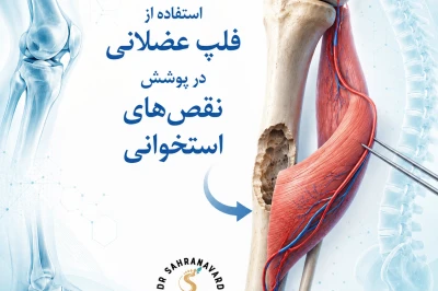 استفاده از فلپ‌های عضلانی در پوشش نقص‌های استخوانی | رویکردی پیشرفته در بازسازی بافت‌های اسکلتی