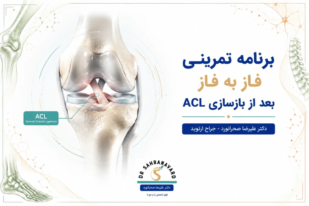 برنامه تمرینی فاز به فاز بعد از بازسازی ACL | راهنمای جامع توانبخشی رباط صلیبی قدامی