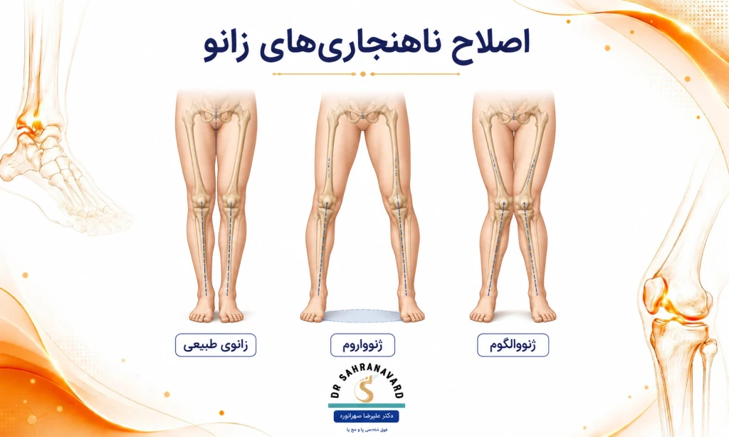 تمرینات اصلاحی برای ناهنجاری‌های زانو (ژنوواروم و ژنووالگوم)