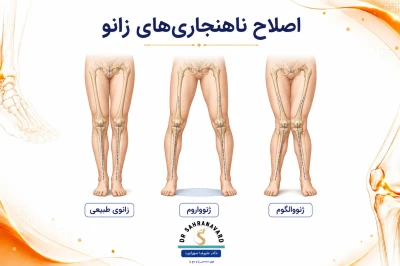 تمرینات اصلاحی برای ناهنجاری‌های زانو (ژنوواروم و ژنووالگوم)