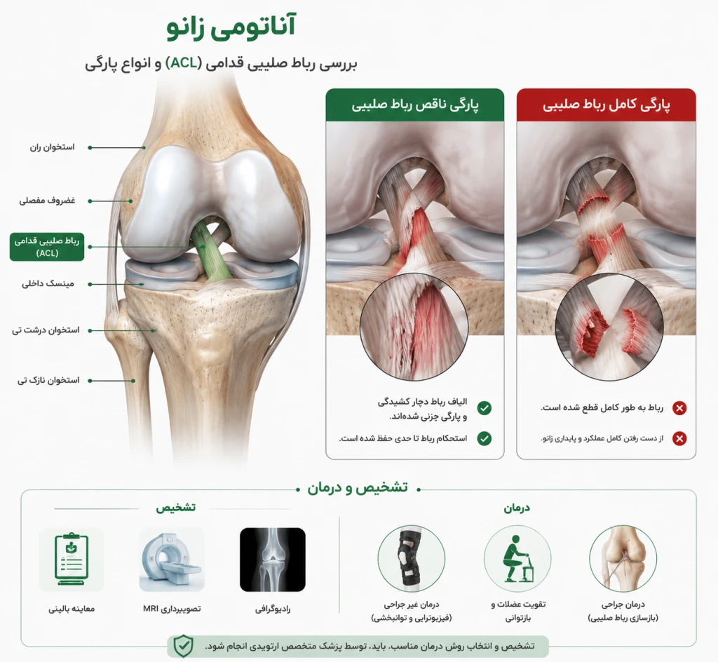 تفاوت پارگی ناقص و کامل رباط صلیبی | بررسی شدت آسیب زانو