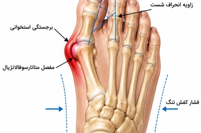 علائم هشداردهنده انحراف شست پا | چه زمانی قوز شست پا نیاز به بررسی تخصصی ارتوپدی دارد؟