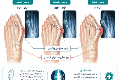 بررسی شدت بونیون پا توسط جراح ارتوپد | تشخیص نیاز به درمان هالوکس والگوس