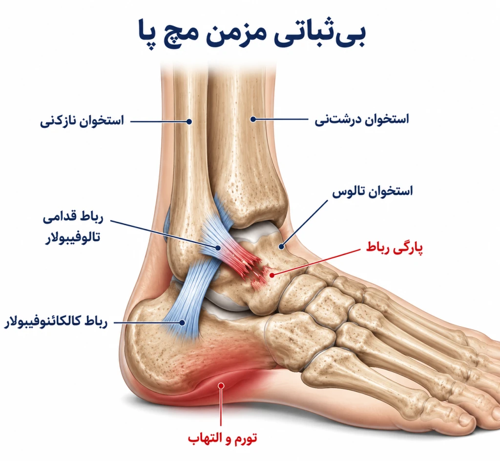 پیچ‌خوردگی مچ پا چه زمانی نشانه بی‌ثباتی مزمن مچ پا است؟ | بررسی علائم و روش‌های درمان
