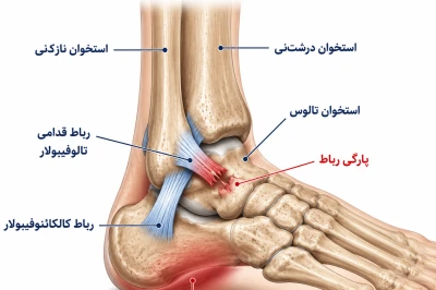 پیچ‌خوردگی مچ پا چه زمانی نشانه بی‌ثباتی مزمن مچ پا است؟ | بررسی علائم و روش‌های درمان