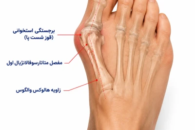 مهم‌ترین علت‌های هالوکس والگوس و نقش ژنتیک در انحراف شست پا | بررسی عوامل ایجاد قوز شست پا