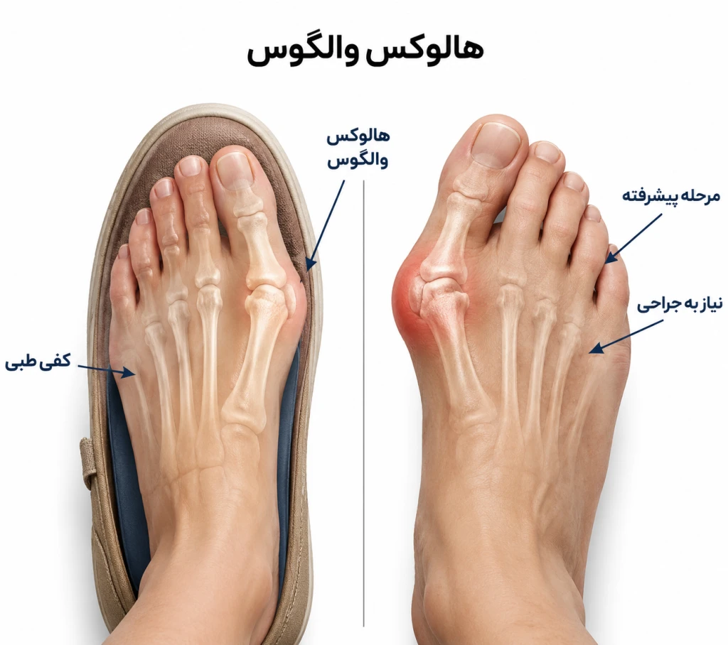 چه زمانی کفش و کفی طبی برای هالوکس والگوس کافی نیست؟ | بررسی زمان نیاز به درمان تخصصی قوز شست پا
