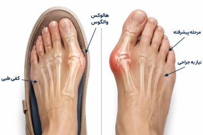 چه زمانی کفش و کفی طبی برای هالوکس والگوس کافی نیست؟ | بررسی زمان نیاز به درمان تخصصی قوز شست پا