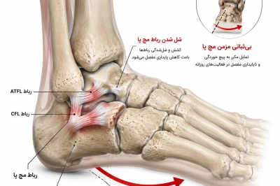 شل بودن رباط‌های مچ پا چه نقشی در بی‌ثباتی مزمن مچ پا دارد؟