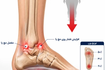 ارتباط اضافه وزن با درد هالوکس والگوس و پیچ‌خوردگی‌های مکرر مچ پا | بررسی تأثیر وزن بدن بر سلامت پا و مچ پا