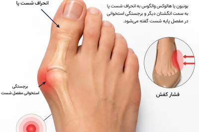چگونه افزایش سن باعث پیشرفت بونیون پا و درد مفصل شست می‌شود | بررسی تأثیر پیری بر هالوکس والگوس