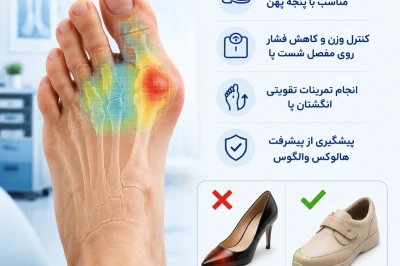 اصلاح سبک زندگی برای کنترل درد بونیون پا و جلوگیری از جراحی