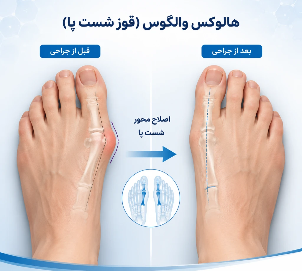 جراحی هالوکس والگوس چگونه درد شست پا و اختلال راه رفتن را درمان می‌کند؟ | بررسی اصلاح قوز شست پا