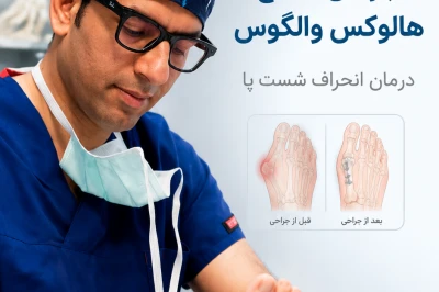 جراحی اصلاح هالوکس والگوس چه زمانی ضروری است؟ | بررسی زمان مناسب جراحی قوز شست پا