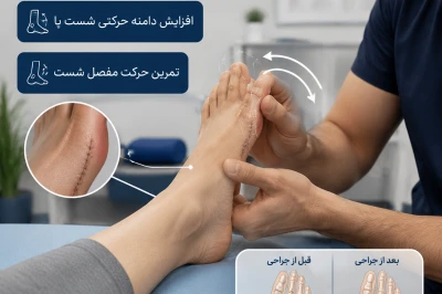 نقش فیزیوتراپی بعد از جراحی بونیون در بازگشت حرکت شست پا | بررسی روند توانبخشی پس از جراحی هالوکس والگوس