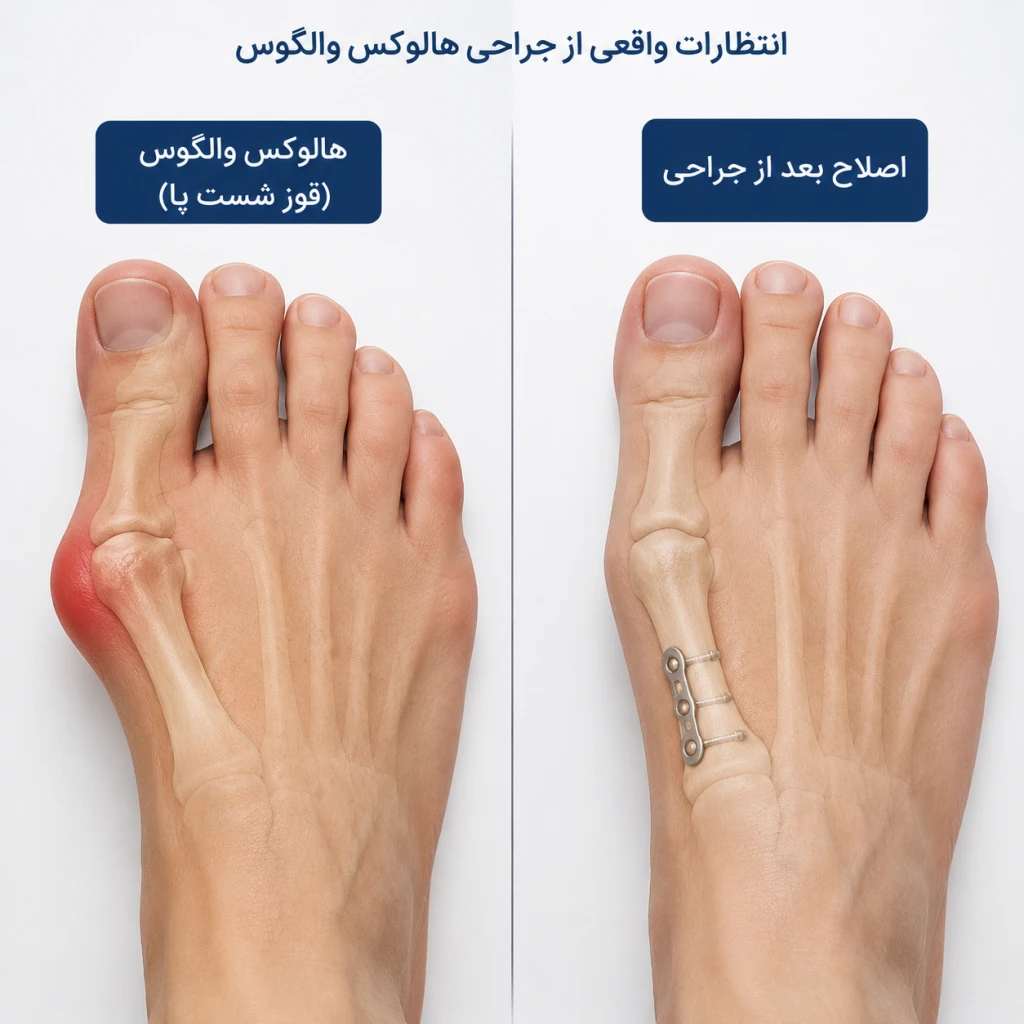 انتظارات واقعی بیمار از جراحی اصلاح هالوکس والگوس | بهبود عملکرد و زیبایی پا
