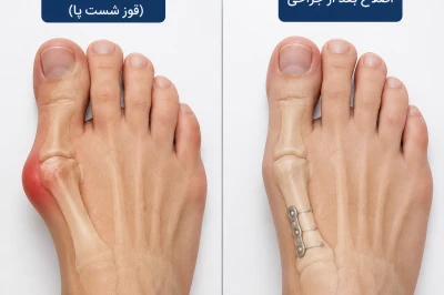 انتظارات واقعی بیمار از جراحی اصلاح هالوکس والگوس | بهبود عملکرد و زیبایی پا