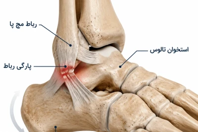 ترمیم رباط مچ پا چه زمانی برای بی‌ثباتی مزمن ضروری می‌شود؟ | بررسی دلایل جراحی رباط مچ پا