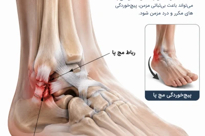 مزایا و محدودیت‌های جراحی بی‌ثباتی مچ پا در ورزشکاران | بررسی درمان ناپایداری مچ پا