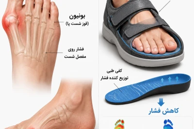 کفش و کفی طبی مناسب چگونه فشار روی بونیون پا را کاهش می‌دهند؟ | بررسی روش‌های کاهش درد قوز شست پا