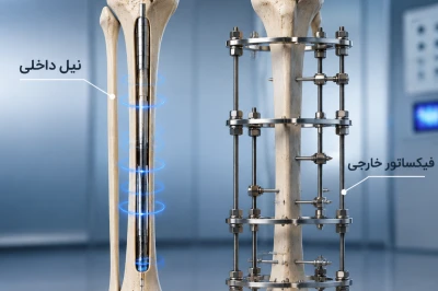 تفاوت فیکساتور خارجی و نیل داخلی در جراحی افزایش قد | مقایسه روش‌های Limb Lengthening