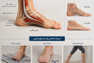 بهترین تمرینات اصلاحی برای تقویت قوس کف پا چیست | درمان غیرجراحی صافی کف پا